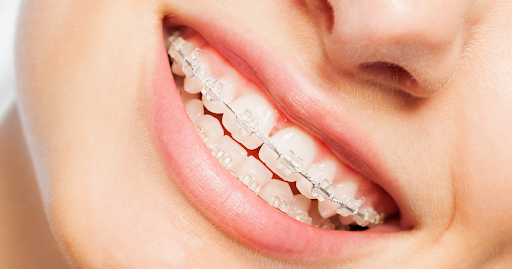 Pros and Cons of Ceramic Braces to Improve Your Smile